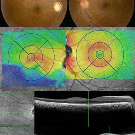 thickness measurement of retinal layers|retinal thickness normal range.